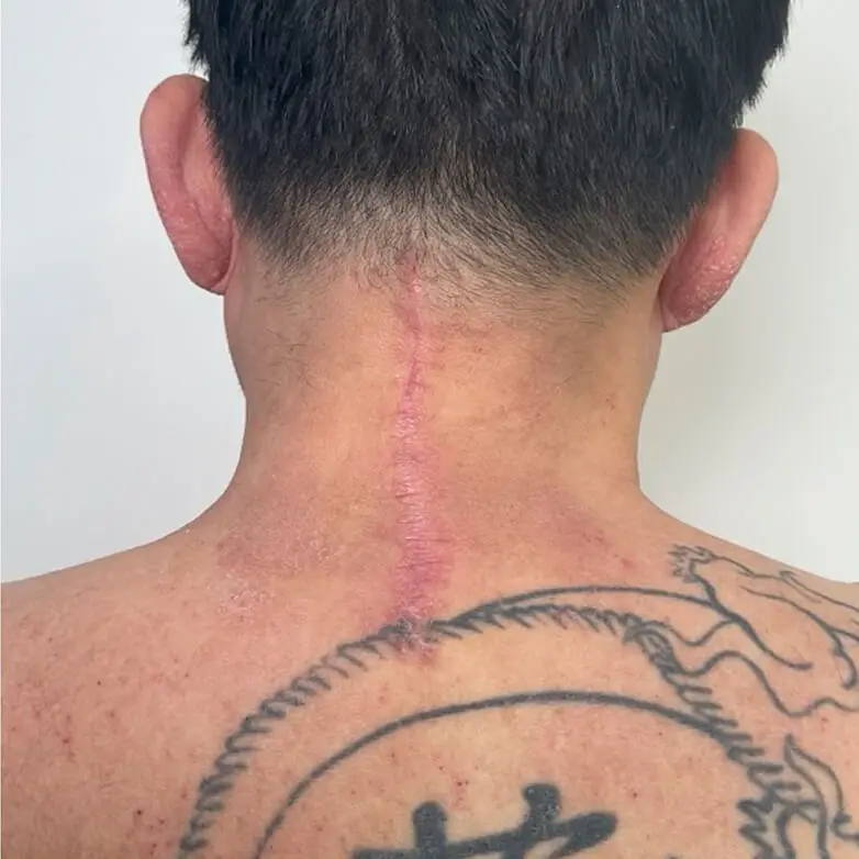 Lipoma - After