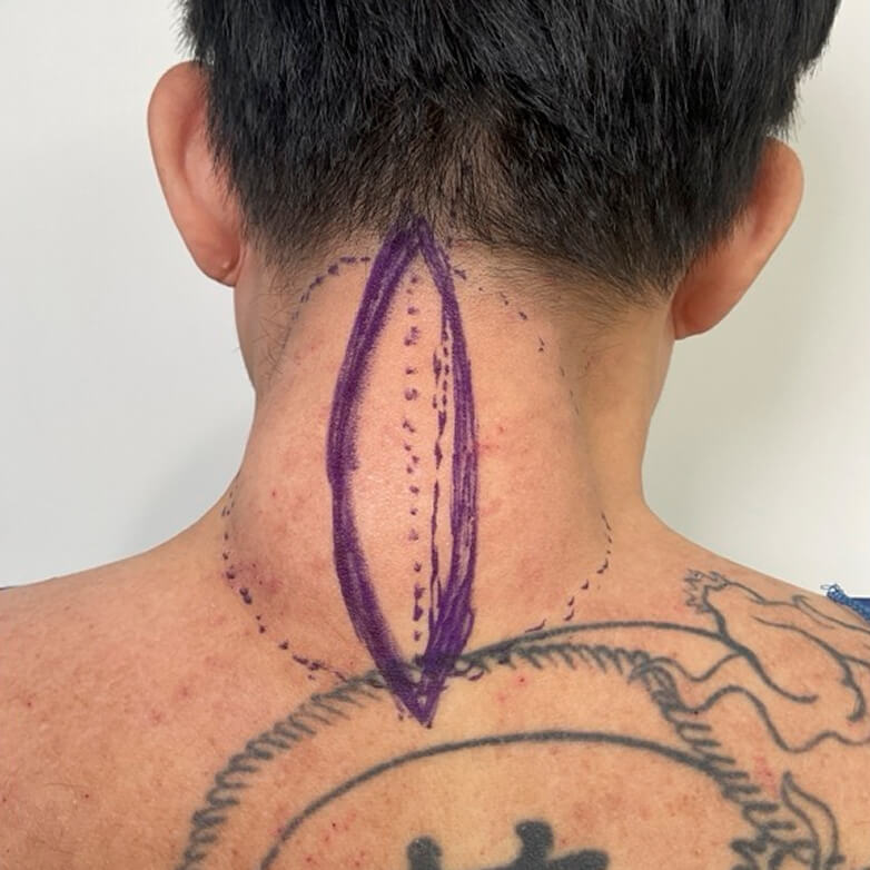 Lipoma - Before