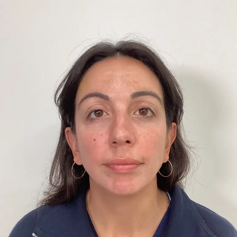 Melasma - After