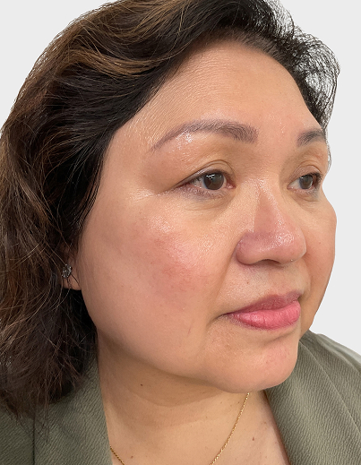 Melasma Enlighten Peel - After