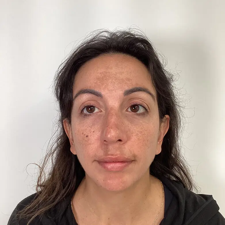 Melasma - Before