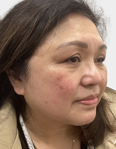 Melasma Enlighten Peel - Before
