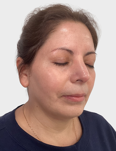 Rosacea DermaV - After