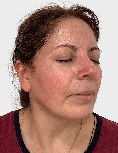 Rosacea DermaV - Before