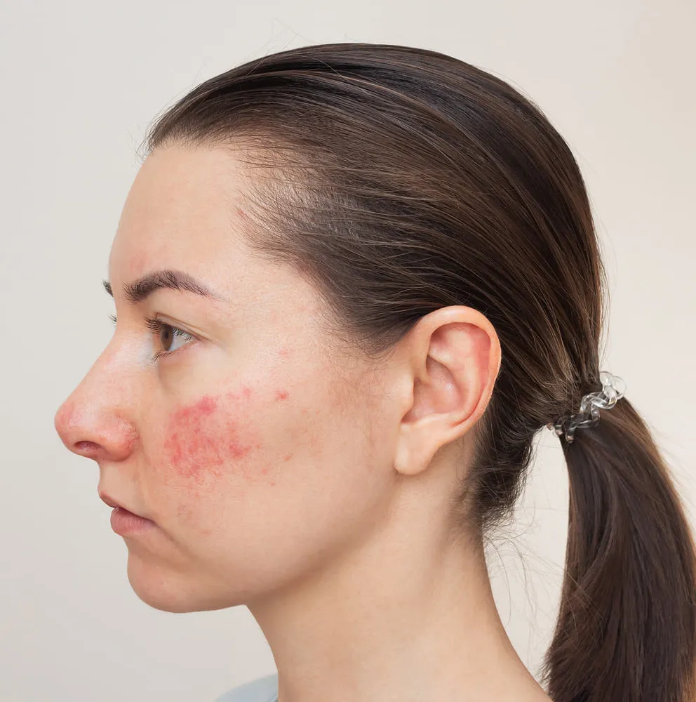 Rosacea