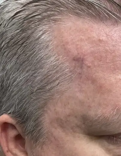 Scar DermaV - After