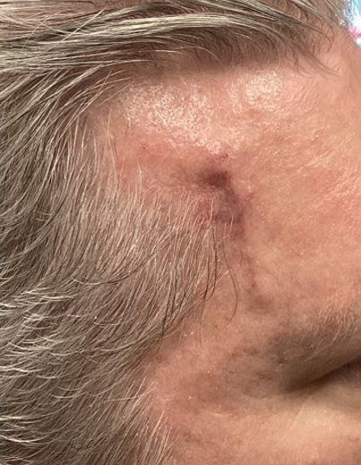 Scar DermaV - Before