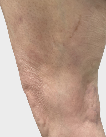 Spider Vein Treatment - After