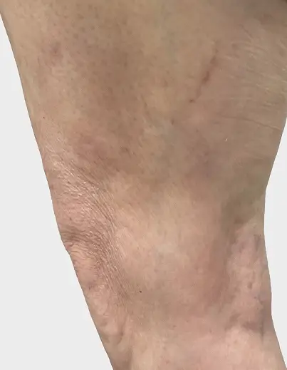 Spider Vein Treatment - After