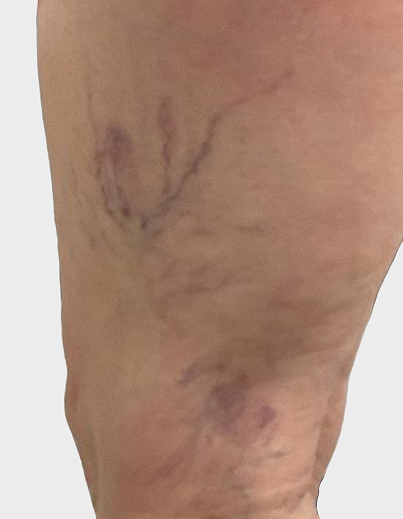 Spider Vein Treatment - Before