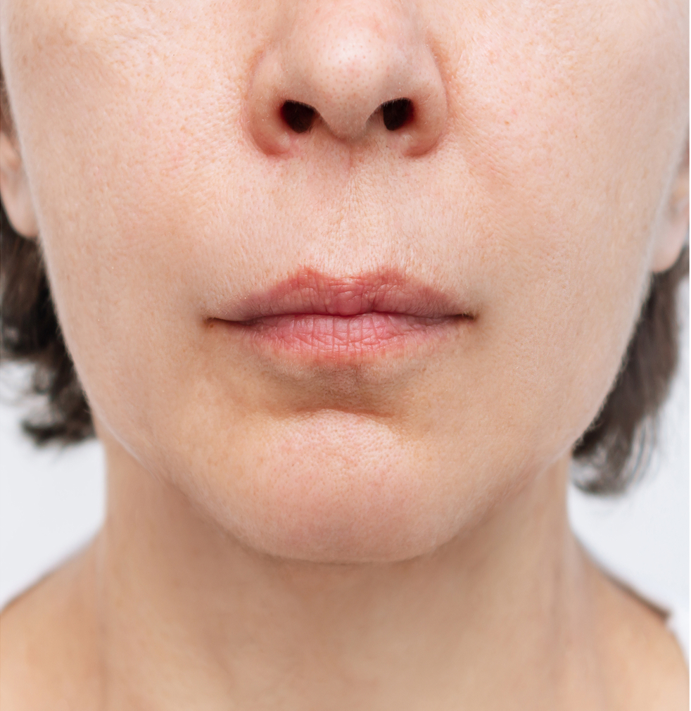 After treatment