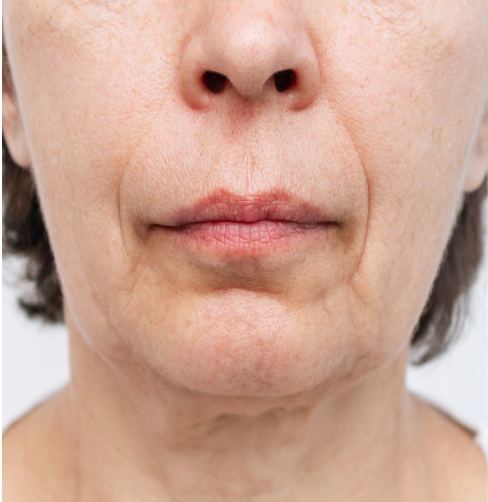 Before treatment